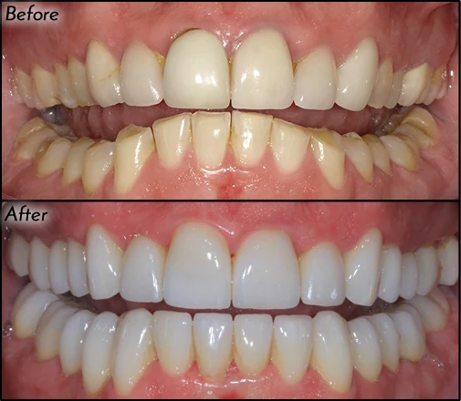Before and after cosmetic dentistry by Dr. Rob Smith
