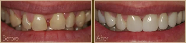 A closed front-tooth gap, before and after