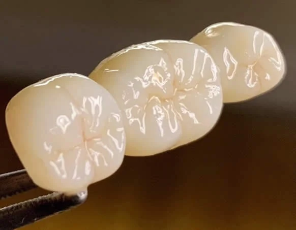 Porcelain work made for a patient at the dental lab Dr. Smith uses in Fresno