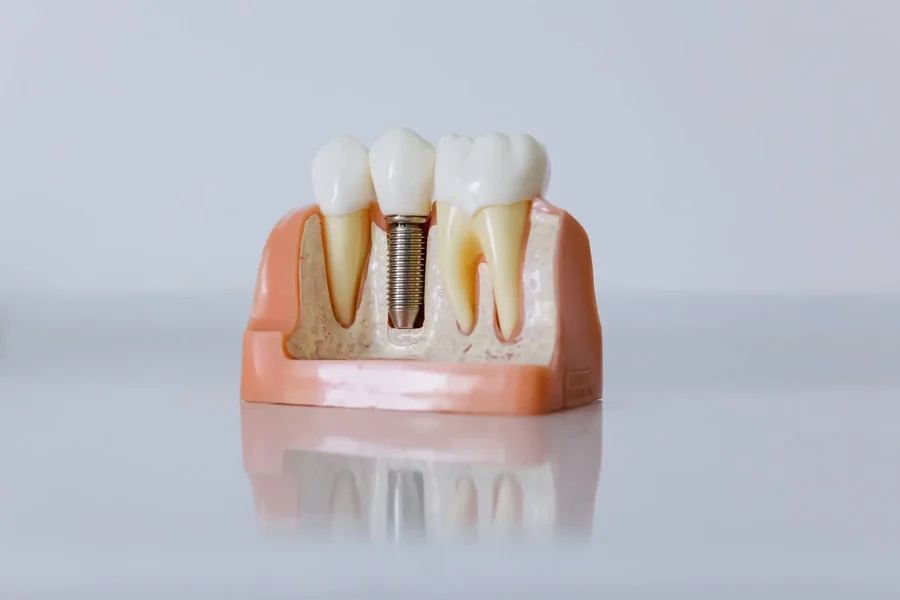A dental implant model showing how an implant replaces a missing tooth