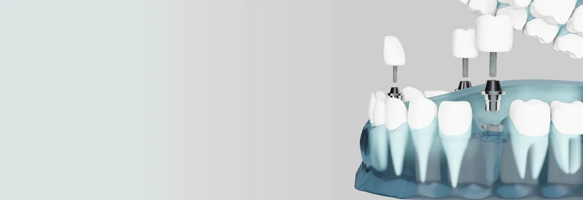 A guided dental implant model showing an implant placed in the jaw