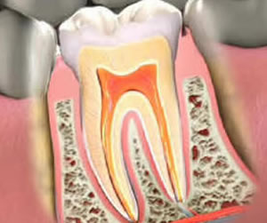 Link to more info about Root Canal Therapy