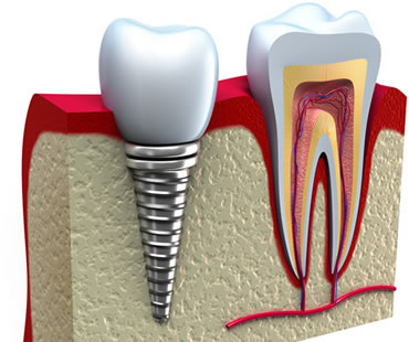 dental implants dentist in Fresno