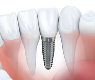 Improve your Oral Health with Dental Implants in Fresno