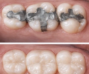 white-fillings-1 white fillings 1